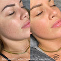 Dry Skin Needling Deposit