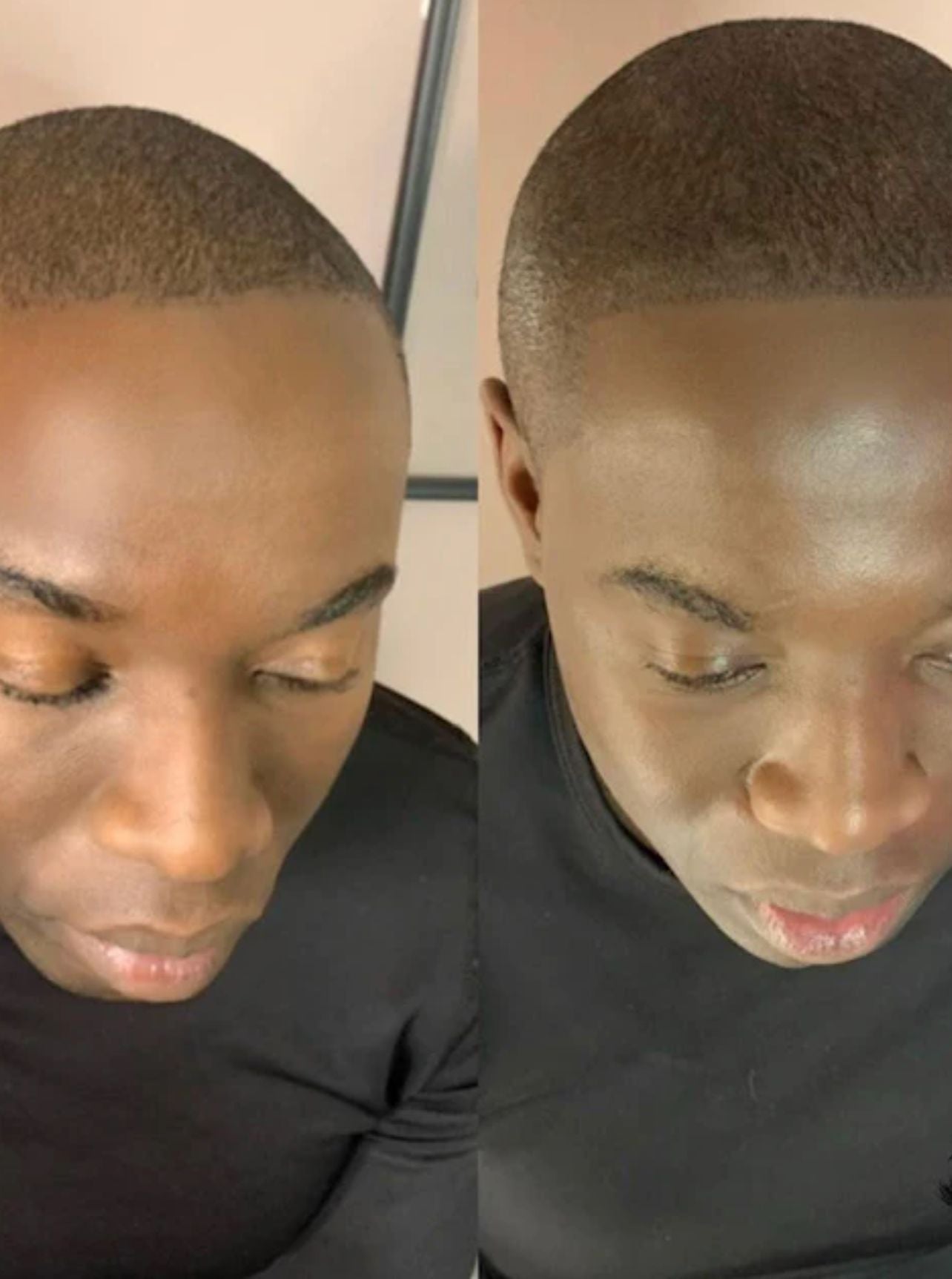 Male Scalp Micropigmentation [SMP] (Deposit)