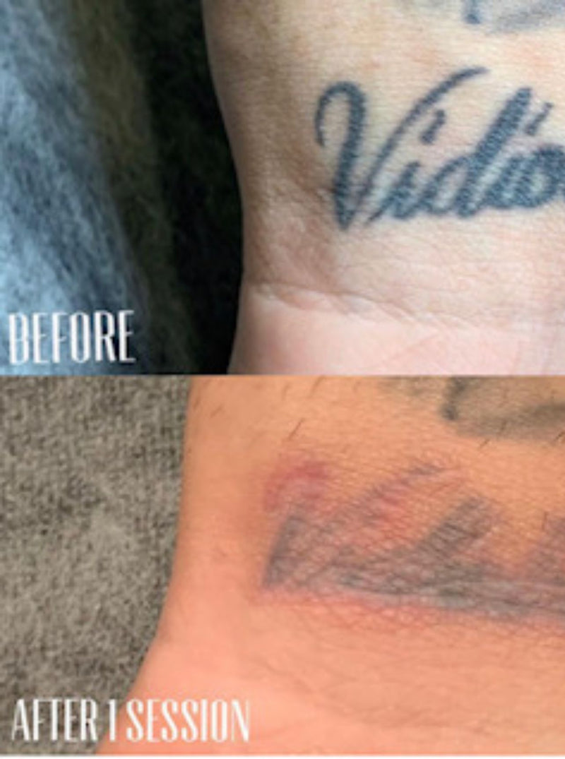 Non-Laser Tattoo Removal Deposit