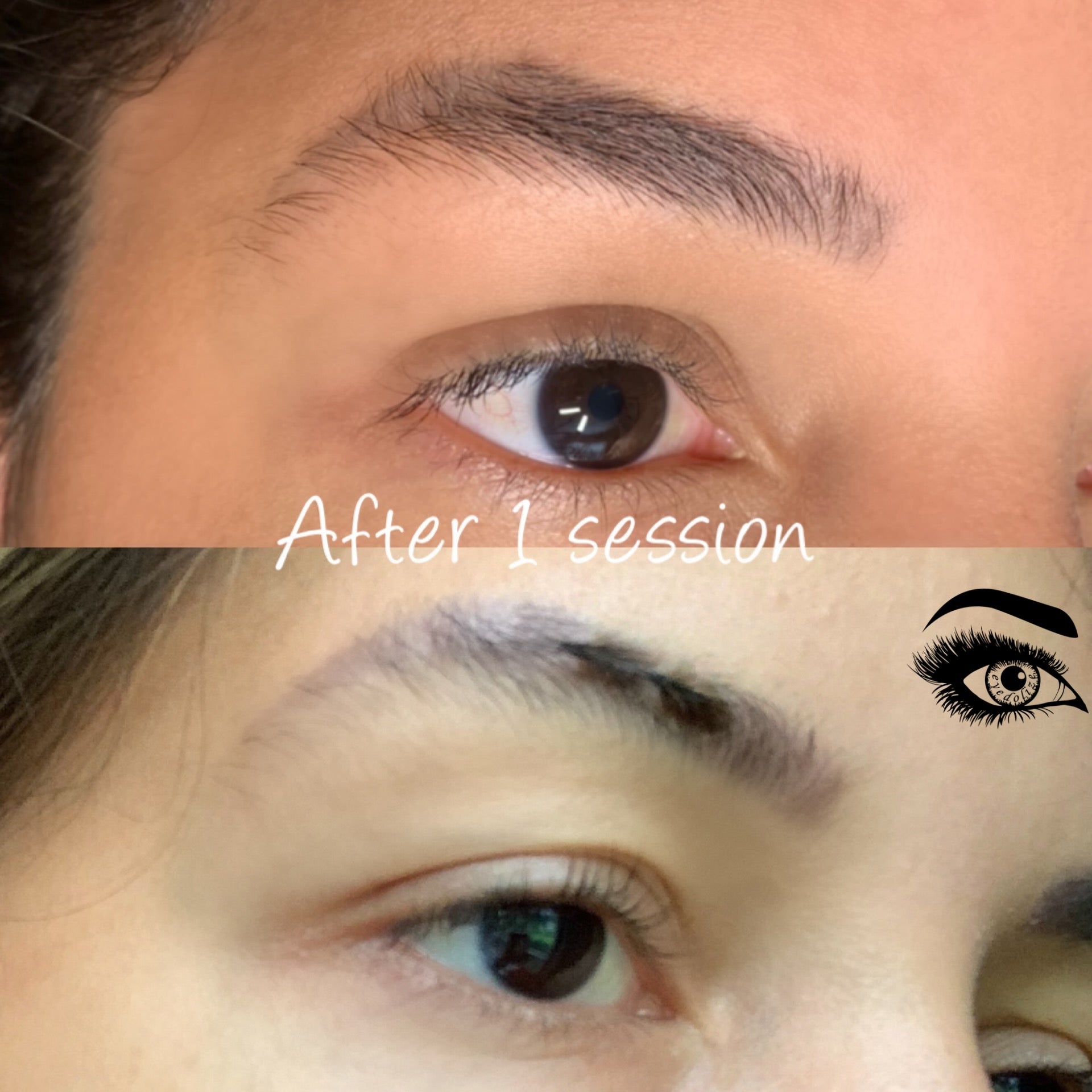 Botched Ink Removal